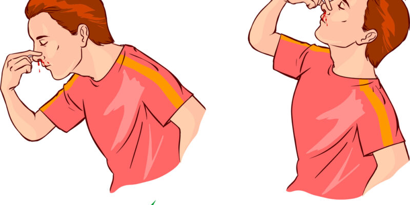 КОГА КРВАРЕЊЕТО ОД НОСОТ Е СЕРИОЗЕН ПРОБЛЕМ?