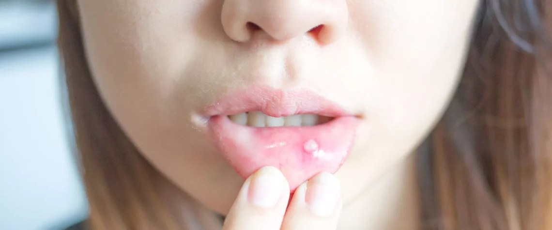 РАНИ  И АФТИ  ВО УСТАТА