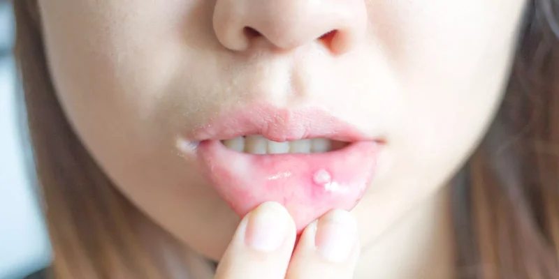 РАНИ  И АФТИ  ВО УСТАТА